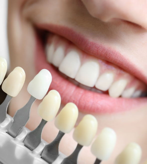 Professional Teeth Whitening in Lahore