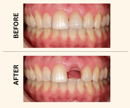 Dental Implant Offer in lahore - Before & After Results