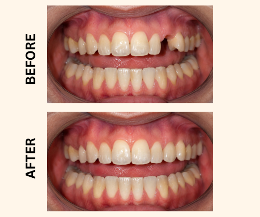 Dental Implant Offer in lahore - Before and After Results