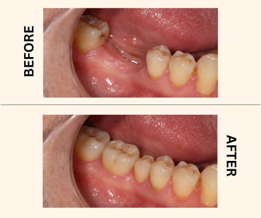 Dental Implants Offer - Before & After Results