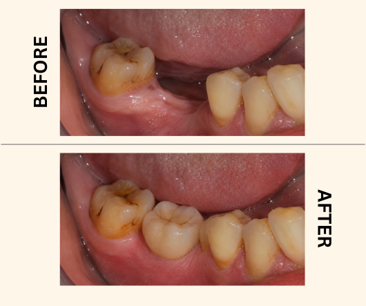 Dental Implants Offer - Before & After